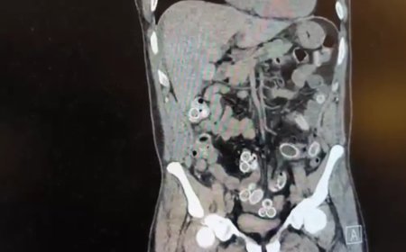 Ağrıyla hastaneye gitti, hepsini midesine gizlemiş. Tutuklandı