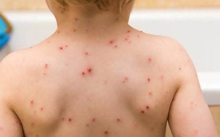 Okullarda suçiçeği vakaları görülmeye başladı