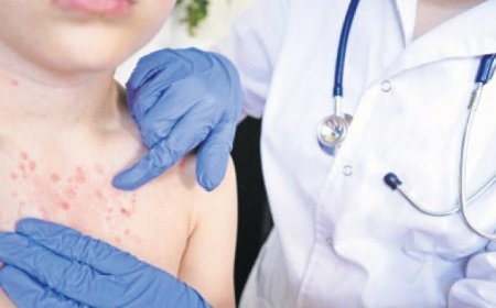 Geri mi dönüyor? Su çiçeği vakalarında artış