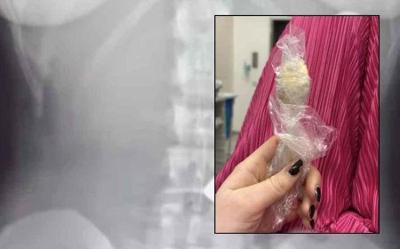 SON DAKİKA HABERLER: .Yoğurt yerken bir anda oldu, söylemeye utandı! Tam 17 santimetre büyüklüğünde, 2 gün vücudunda kaldı