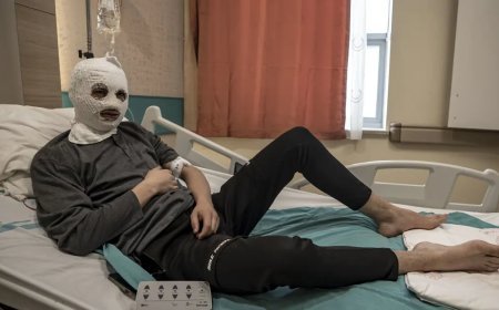 Çakmak gazı tüpü elinde patladı. Bütün yüzü ve göğsü yandı