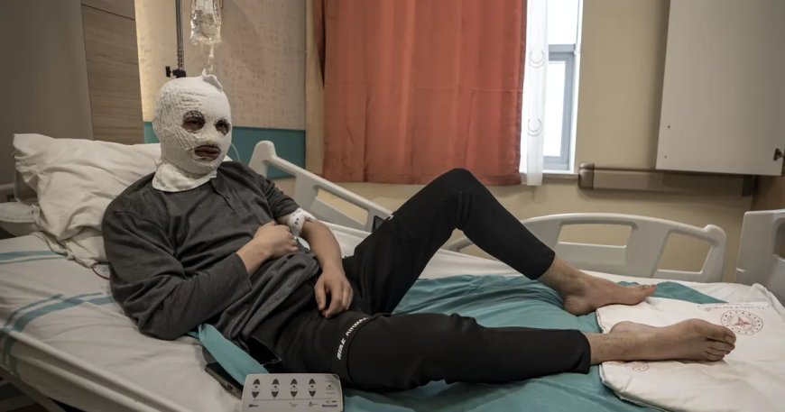 Çakmak gazı tüpü elinde patladı. Bütün yüzü ve göğsü yandı