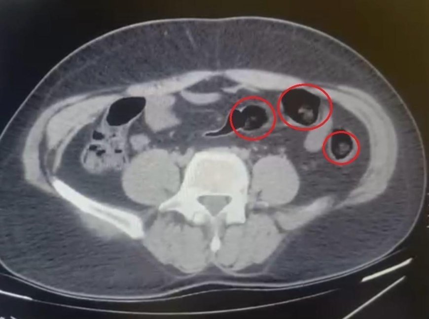 Yolcu otobüsünde şoke eden operasyon! Mide ve bağırsaklarından yarım kilo uyuşturucu çıktı