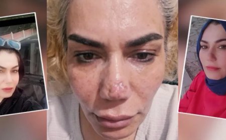 Estetik ameliyatında burnu bu hale geldi, doktordan şikayetçi oldu