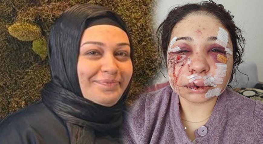 Yüzüne 60 dikiş atılmıştı! Eşini darbeden polis memuru tahliye edildi
